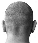 Hair Loss Baldness